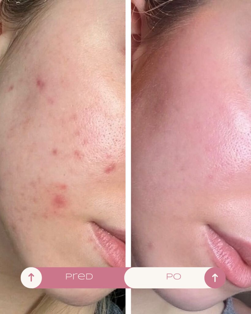 Chemicky peeling