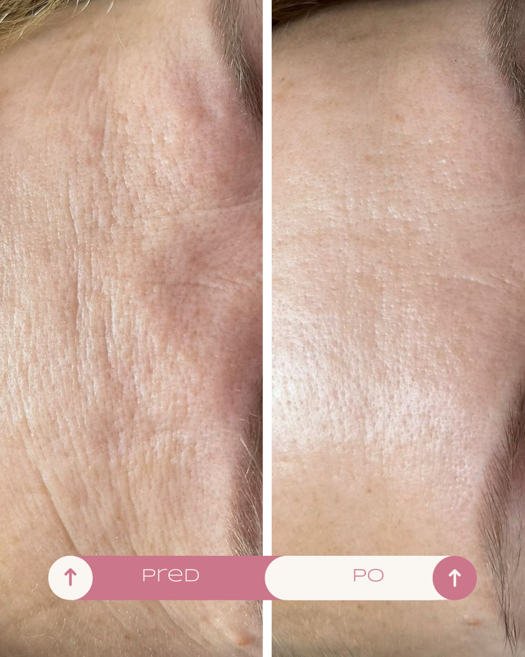 microneedling-kosice-before-after-1