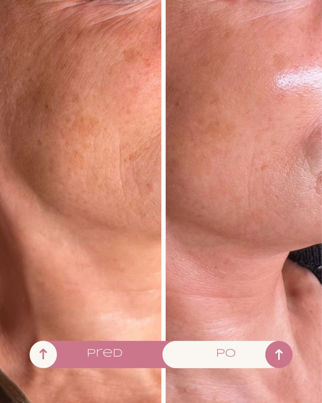 microneedling-kosice-before-after-2