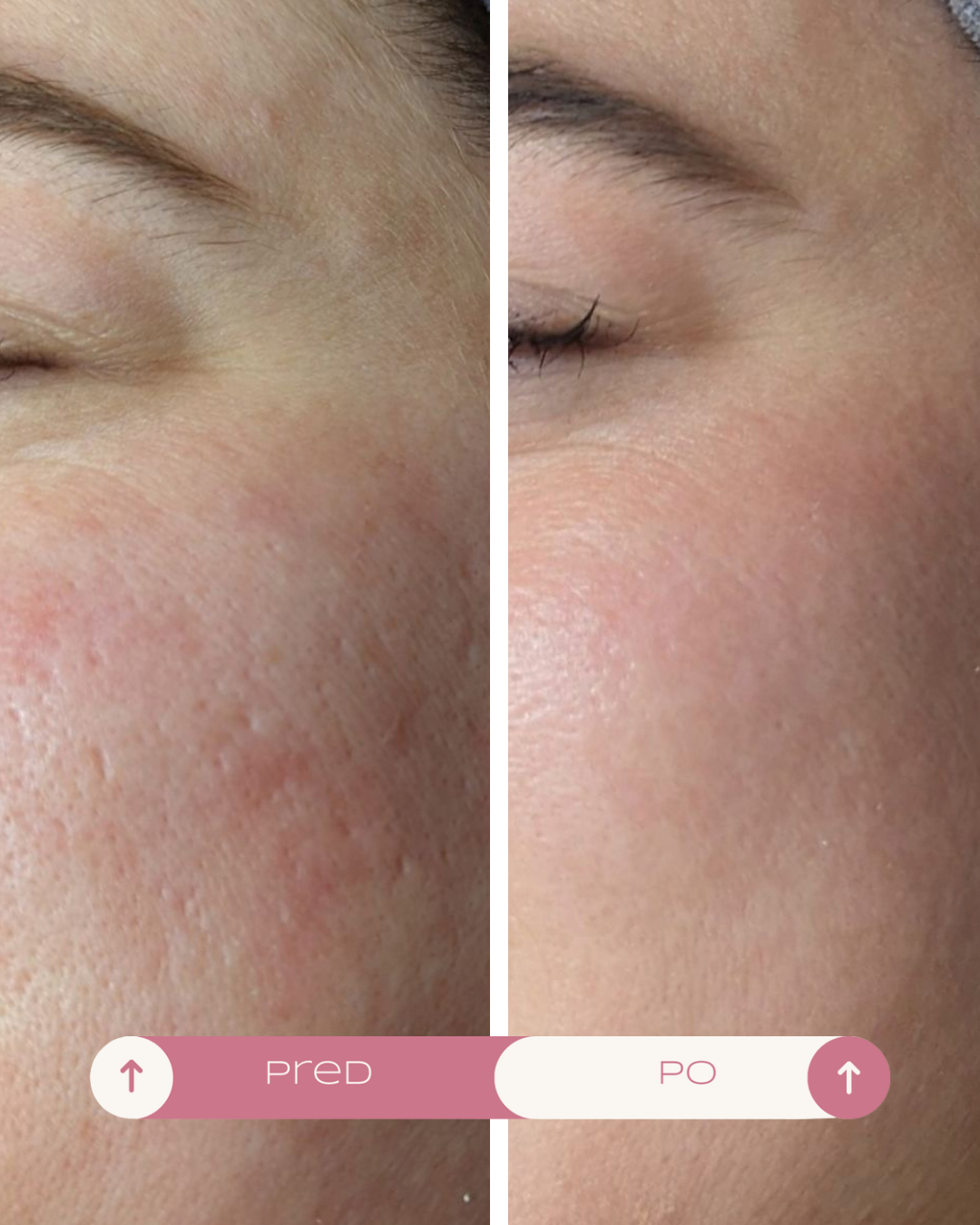 microneedling-kosice-before-after-3