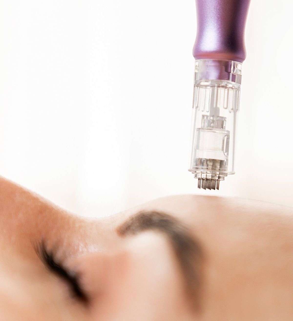 microneedling kosice