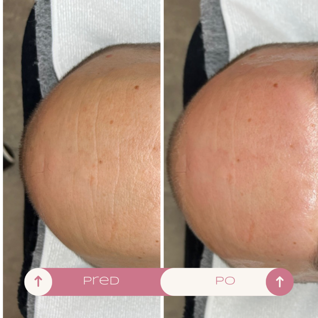 Rýchle liftingové ošetrenie v košiciach